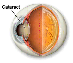 the location of a cataract in an eye